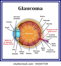 Normal vision. Glaucoma. Chronic eye pathology.