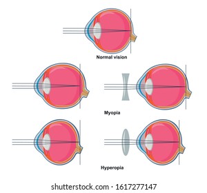 Normal vision, myopia and hyperopia