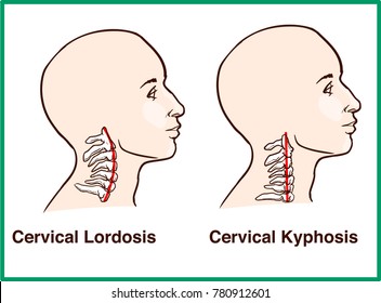 Normal vs. Reversal of Cervical Lordosis
