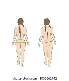 normal and wrong gait of a woman. medical recommendations. vector illustration.
