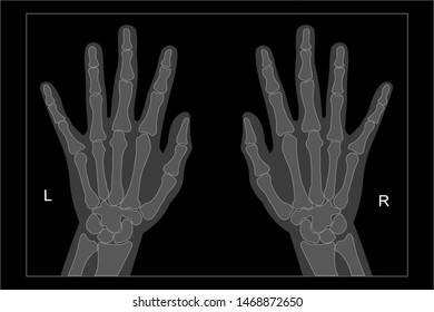Normal x-ray of hand and wrist, both left and right hand.