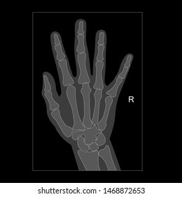 Normal x-ray of hand and wrist, right hand.