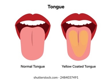 Normal and Yellow coated tongues