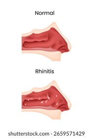 Anatomia do Nariz Normal vs Rinite