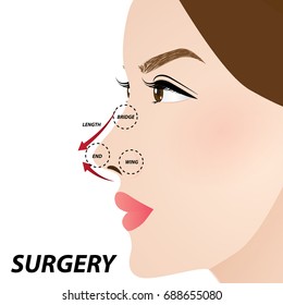 nose beauty surgery , rhinoplasty vector illustration