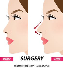 nose beauty surgery , rhinoplasty vector illustration