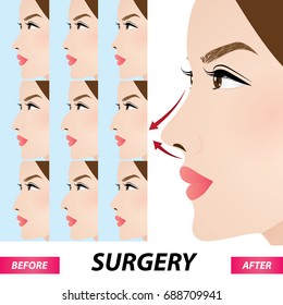 nose beauty surgery , rhinoplasty vector illustration