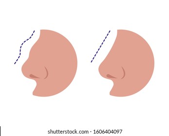 Nose before and after rhinoplasty correction isolated on a white background. Comparison of female nose after plastic surgery. Vector illustration of a rhinoplasty concept.