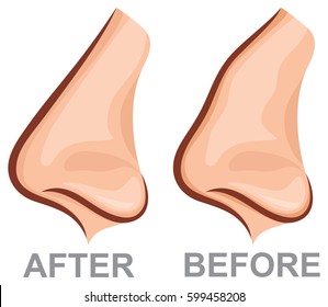 nose before and after rhinoplasty (plastic surgery vector illustration)
