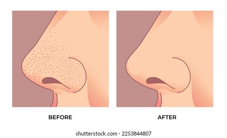 Nose with blackheads, Enlarged pores on the face. Acne treatment before and after. Skin care concept.