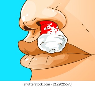 Nose bleed. Cotton in the nose. How to stop the nosebleed. Medical illustration, healthcare illustration. Vector illustration.