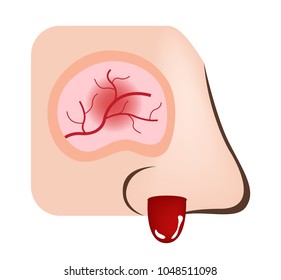 nose bleeding vector / inflamed nasal and sinus