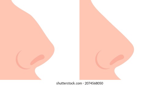 The nose is crooked and the nose is straight. Concept: rhinoplasty, before and after surgery. Vector illustration, flat cartoon color minimal design isolated on white background, eps 10.