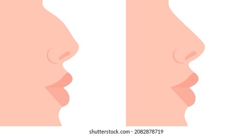 The nose is crooked and the nose is straight. Rhinoplasty. Man's face in profile. Vector illustration, flat minimal cartoon color design, isolated on white background, eps 10.