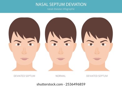 Nose Deviated Septum. Nasal diseases. Medical infographic design. Vector illustration