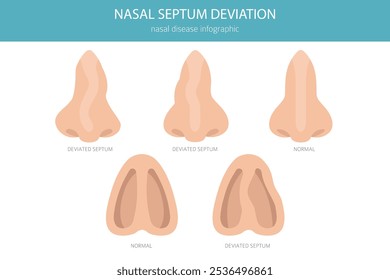 Nose Deviated Septum. Nasal diseases. Medical infographic design. Vector illustration