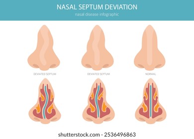 Nose Deviated Septum. Nasal diseases. Medical infographic design. Vector illustration