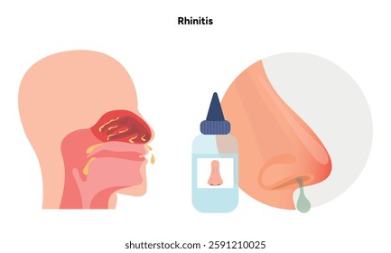 Nose Nasal diseases. Rhinitis symptoms. Allergy, rhinitis or cold medical diagram