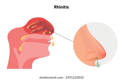 Nose Nasal diseases. Rhinitis symptoms. Allergy, rhinitis or cold medical diagram