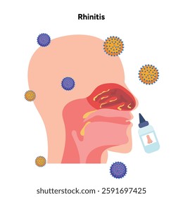 Nose Nasal diseases. Rhinitis symptoms. Allergy, rhinitis, cold medical diagram with viruses and nasal spray