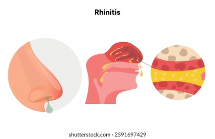 Nose Nasal diseases. Rhinitis symptoms. Allergy, rhinitis or cold medical diagram