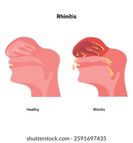 Nose Nasal diseases. Rhinitis symptoms and healthy nasal cavity. Allergy, rhinitis or cold medical diagram