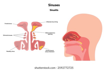 Nose Nasal diseases. Rhinitis symptoms. Allergy, rhinitis, cold medical diagram
