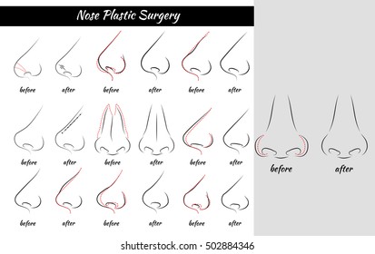 Nose Plastic Surgery. Rhinoplasty. Vector Illustration.