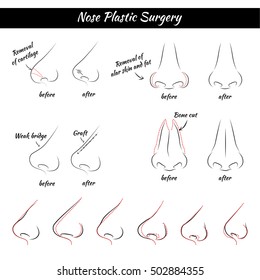 Nose Plastic Surgery. Rhinoplasty. Vector Illustration.