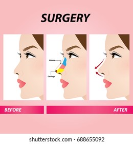 nose plastic surgery , rhinoplasty vector illustration