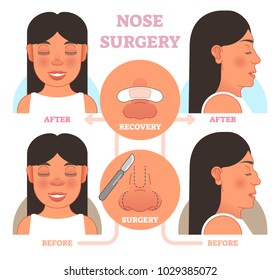 Nose plastic surgery vector illustration. Front and profile views. 