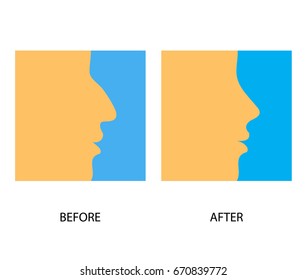 Nose surgery. Before and after vector illustration.