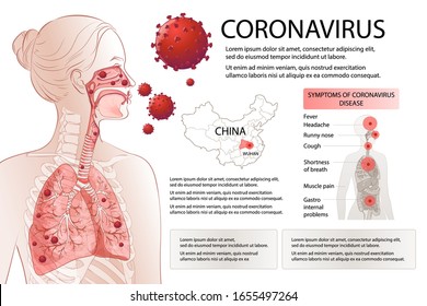 Novel Coronavirus (2019-nCoV) Stop. Human MERS-Cov Symptoms Risk Factors. Virus Outbreak Spread Pandemic. Health And Medical Testing, Screening. Respiratory, Breathing. Vector Diagram Infographic