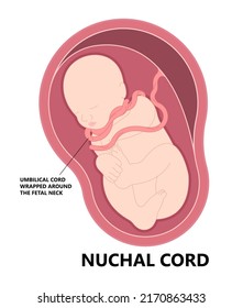 Nuchal cord coil c section baby birth fetal neck Fetal death Knot test born labor fluid Anemia womb fetus Pre eclampsia Vasa previa gestation distress abruption accreta increta