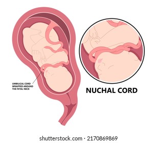 Nuchal cord coil c section baby birth fetal neck Fetal death Knot test born labor fluid Anemia womb fetus Pre eclampsia Vasa previa gestation distress abruption accreta increta