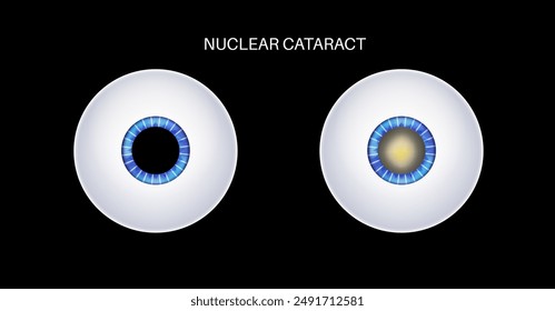 Nuclear cataract disease, eye and pupil anatomy. Lens clouding, vision impairment, and potential blindness. Vision problems during aging. Human vision loss concept. Blindness 3D vector illustration