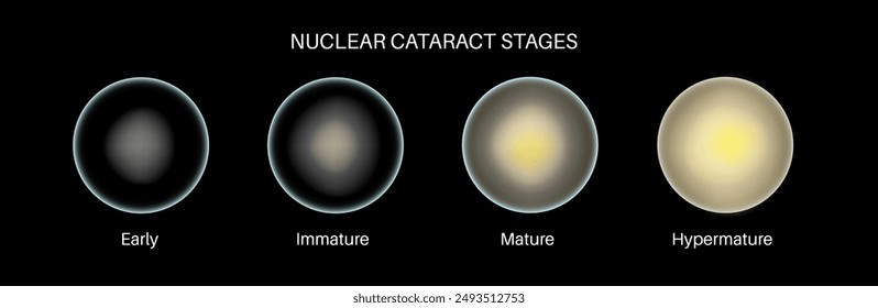 Nuclear cataract disease, eye and pupil anatomy. Lens clouding, vision impairment, and potential blindness. Vision problems during aging. Human vision loss concept. Blindness 3D vector illustration