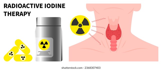 Nuclear medicine for Neck swelling with Radioactive iodine to treat Graves' and Hashimoto's disease
