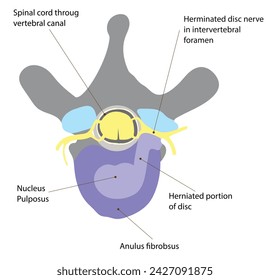 El núcleo pulposo y la compresión de un nervio espinal, lo que resulta en dolor o debilidad muscular en las regiones corporales inervadas por ese nervio.