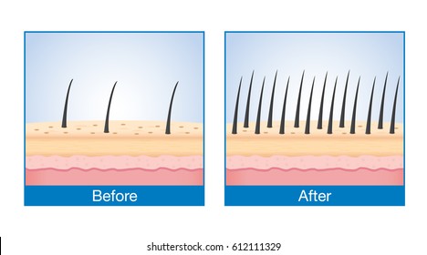 Number of Hair on scalp before and after of treatment hair loss.
