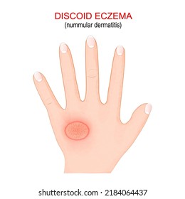 numerisches Ekzem. Das diskoide Ekzem ist ein chronischer Hautzustand, der zu juckender, geschwollener und gerissener Haut führt. Nahaufnahme der Hand eines Menschen mit Krankheitssymptomen. Vektorgrafik