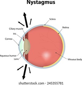 Nystagmus Labeled Diagram Illustration