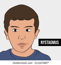 Síndrome de Nystagmus, movimiento involuntario del ojo que puede hacer que el ojo se mueva rápidamente de un lado a otro