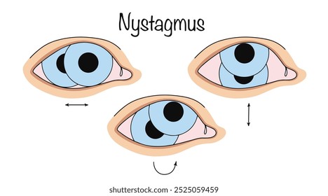 Nistagmo. Temblores o espasmos rítmicos repetitivos e incontrolables de los globos oculares a alta frecuencia. Ilustración vectorial del color con variaciones del movimiento involuntario del ojo.