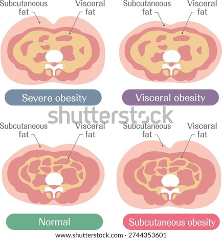 Obesity Levels and Fat Types Severe Visceral and Subcutaneous Illustration