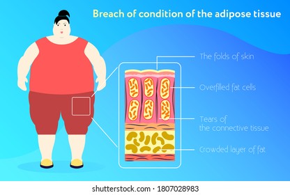 Obesity Medicine poster template in flat design Vector illustration with fat woman and close up scheme of adipose tissue with description