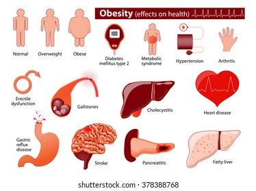 Obesity and overweight infographic. Effects on health.  Medical infographic. Set elements and symbols for your design.