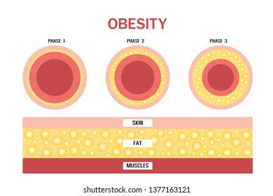 Obesity and overweight, Layers of skin, vector design