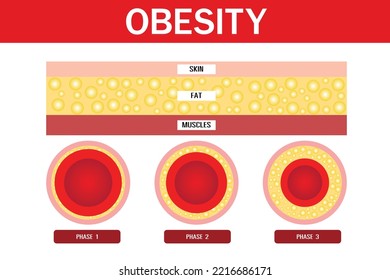 Obesidad y sobrepeso, Capas de piel,diseño vectorial