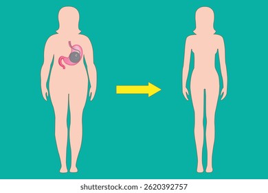 Obesity treatment graphic showing gastric balloon for weight reduction and slim body result. eps 10